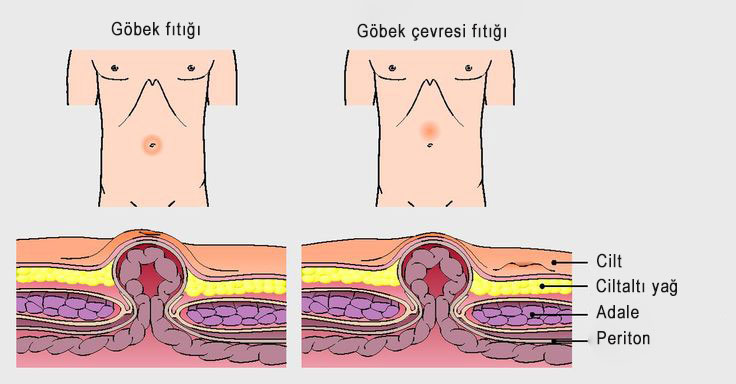 Göbek ve göbek çevresi fıtıkları