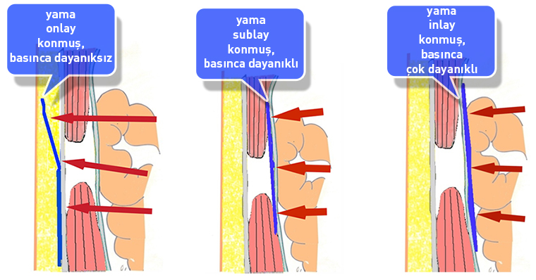 onlay-sublay-inlay2