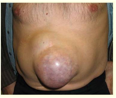 Boğulmuş fıtık; boğulmuş göbek fıtığı. umbilical_hernia